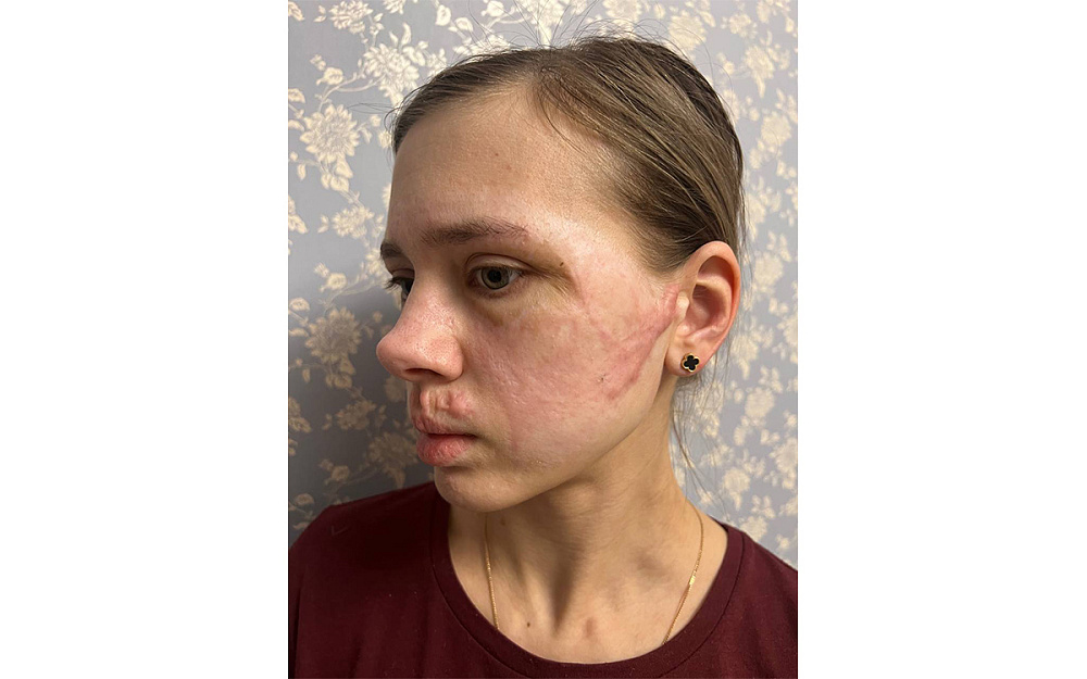 Надія Оксюта після лікування