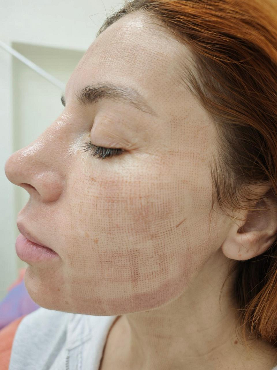 Шкіра після двох процедур UMUS