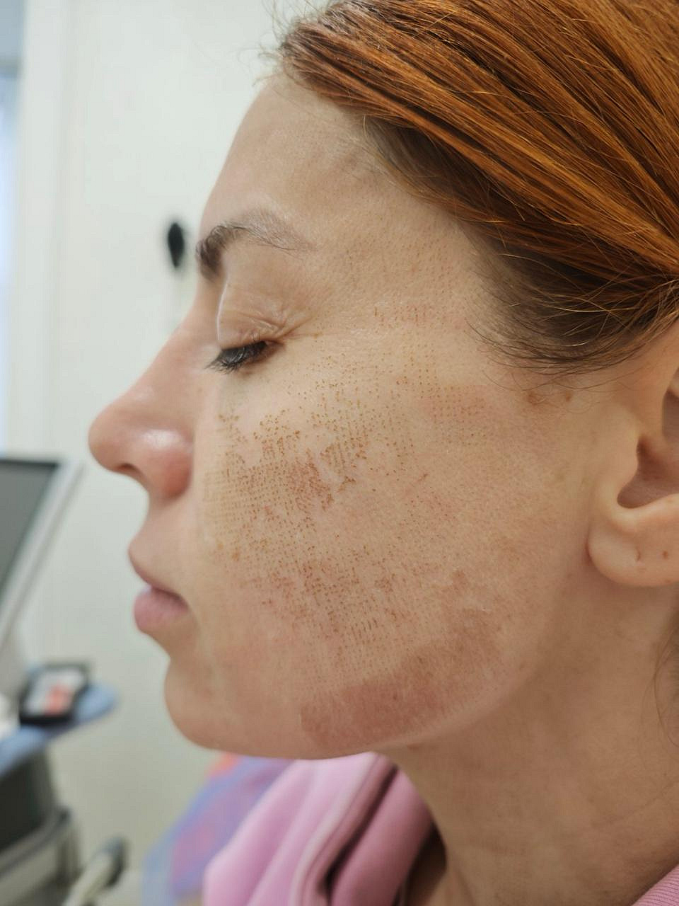 Шкіра після чотирьох процедур UMUS