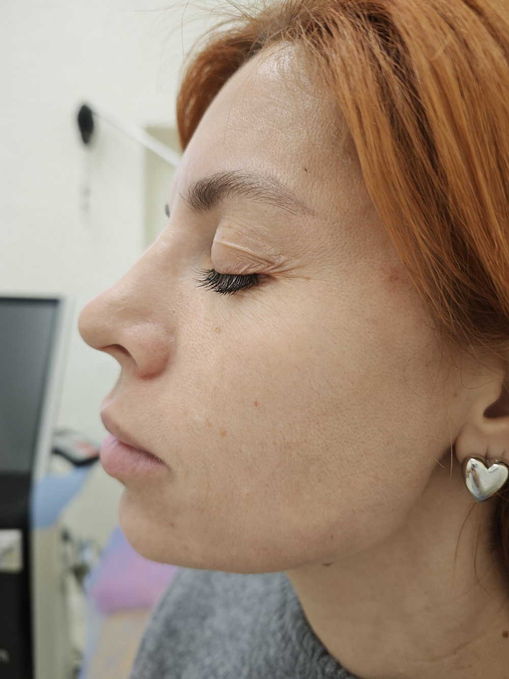 Шкіра після шести процедур UMUS