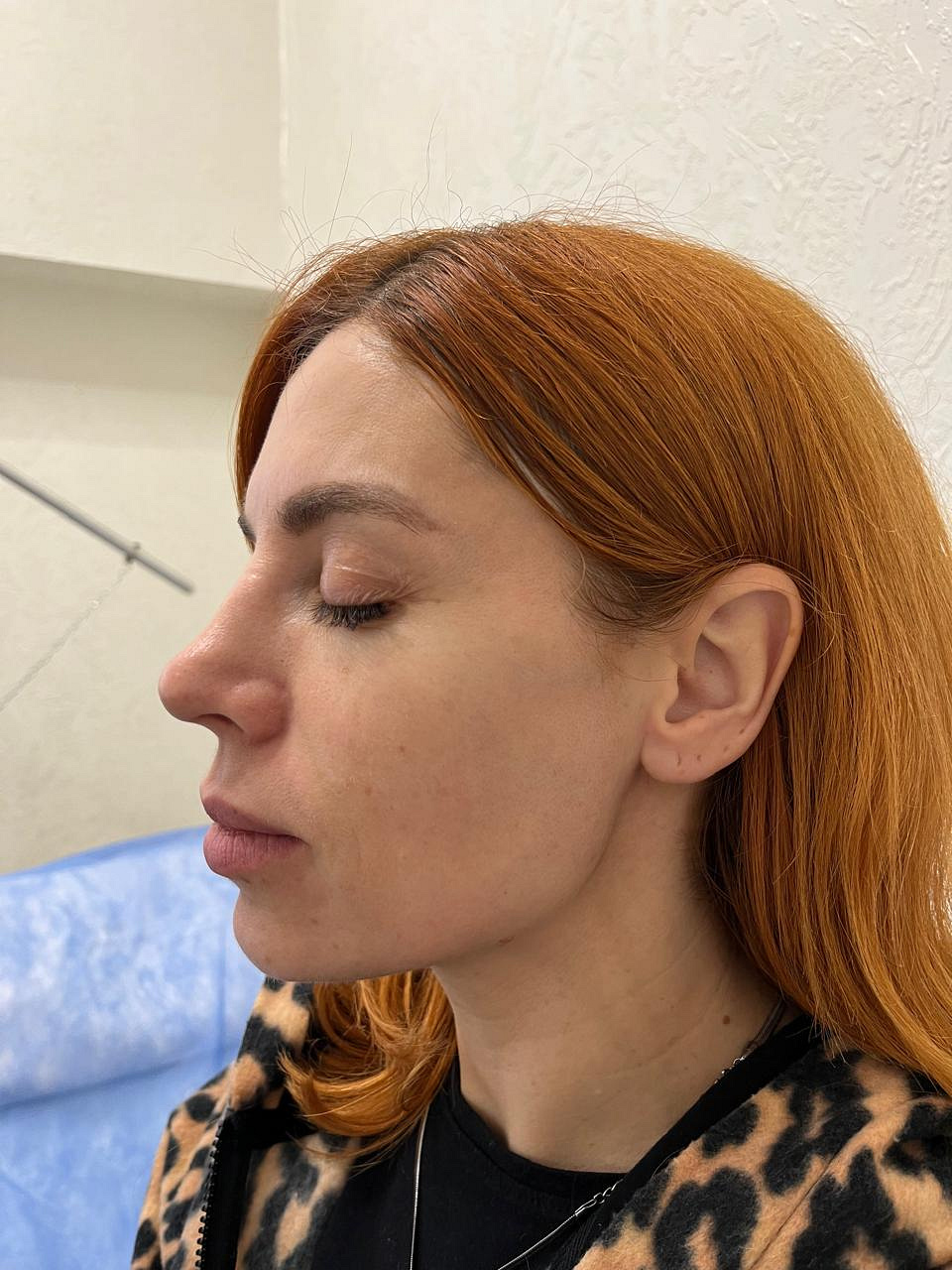 Шкіра після семи процедур UMUS